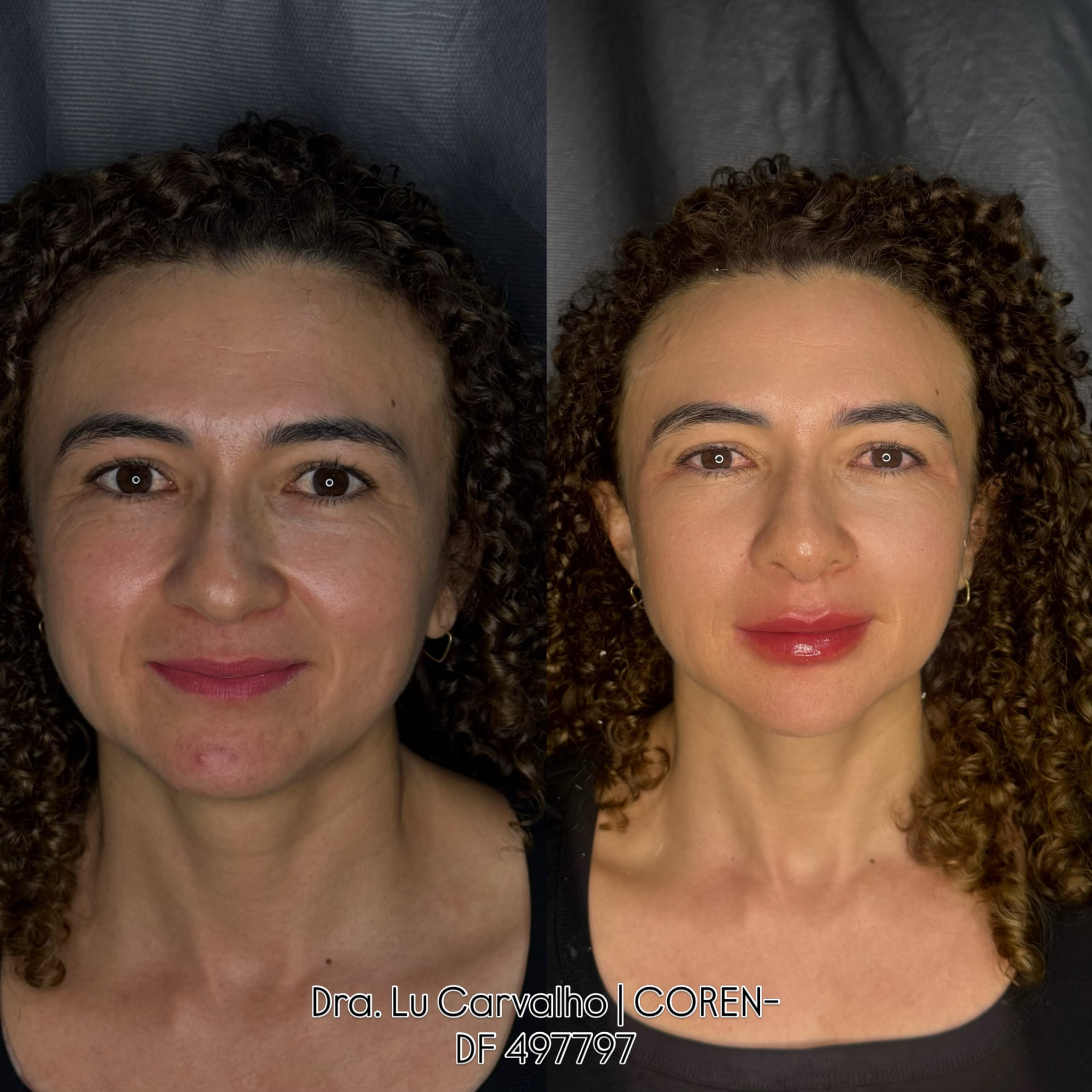 Antes e depois de rejuvenescimento facial